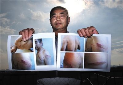 王维龙出示在张家口被关时被虐受伤的照片。 王维龙出示在张家口被关时被虐受伤的照片。