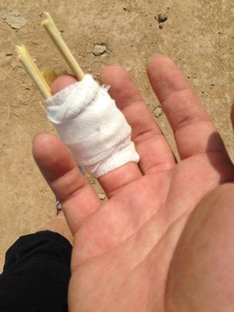 记者受伤的手指。 记者受伤的手指。